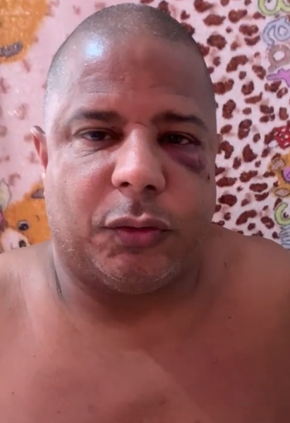 VÍDEO Marcelinho Carioca aparece olho roxo após sair mulher