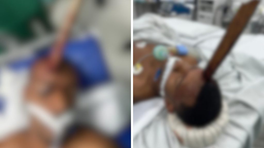 Homem sobrevive após estaca perfurar crânio em acidente de trabalho em Mangaratiba
