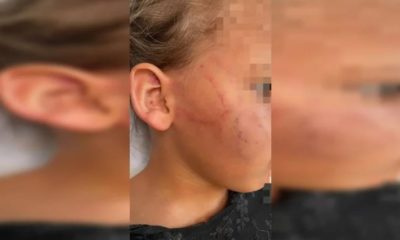 Menina de 4 anos é mordida no rosto pela própria mãe