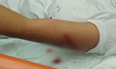 Vítima ficou ferida no braço | Foto: Divulgação
