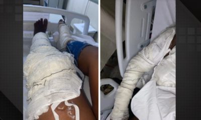 Jovem é atacada com facada no rosto e banho de óleo quente em Bonsucesso