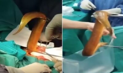 Médicos fazem cirurgia para retirar enguia viva de 60cm do corpo de paciente no Vietnã.