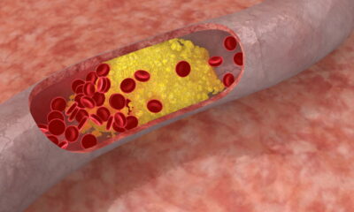 Como controlar o colesterol alto e reduzir o risco de doenças cardiovasculares