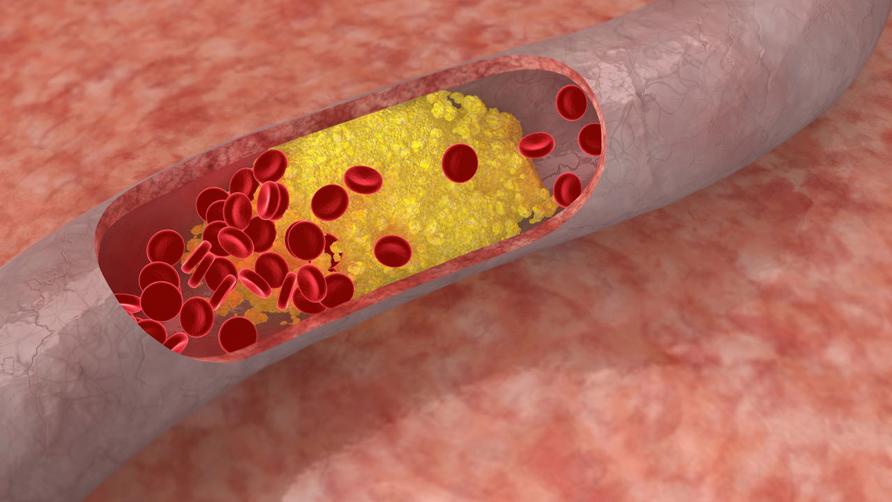 Como controlar o colesterol alto e reduzir o risco de doenças cardiovasculares