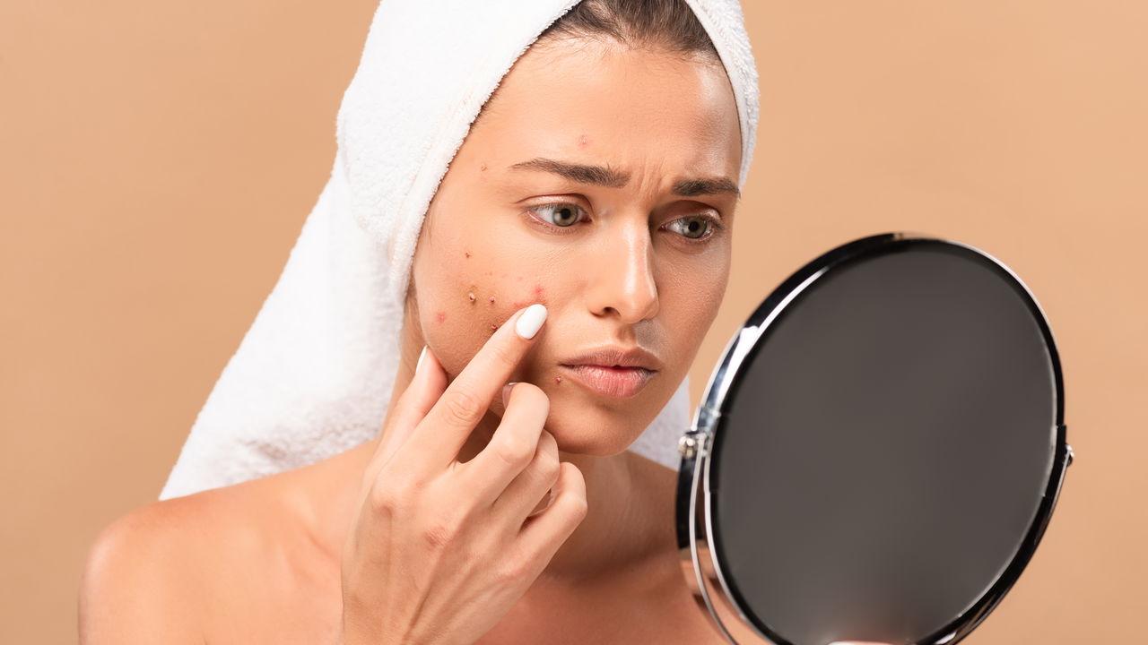 Como manter sua pele livre de acne interna: Prevenção e tratamento