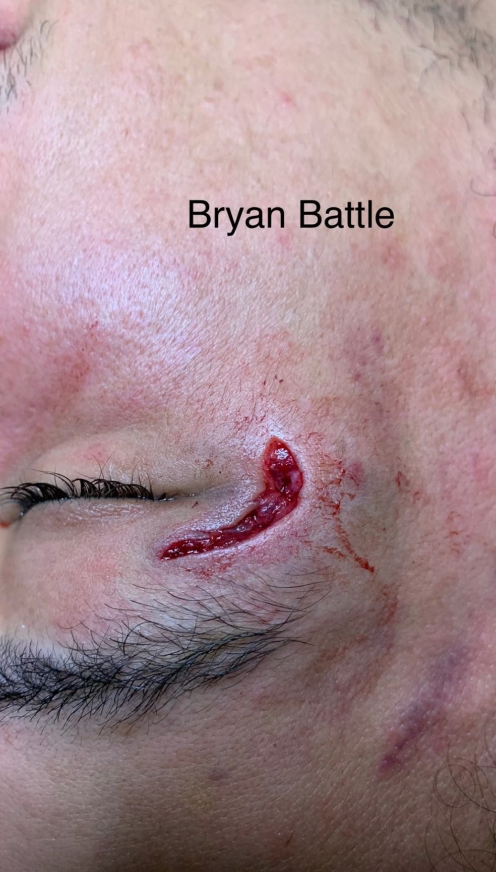 Bryan Battle antes